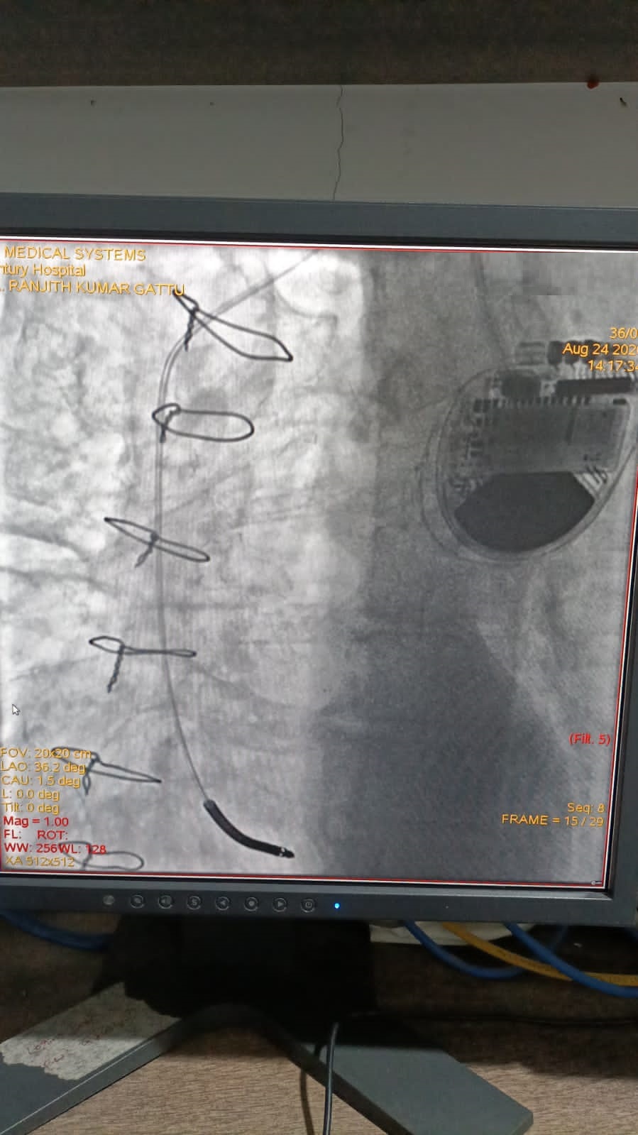 PTCA-RCA pre and post