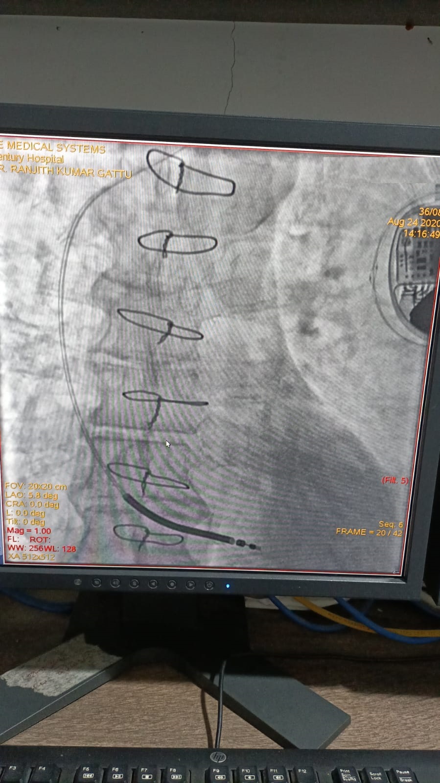 PTCA-RCA pre and post