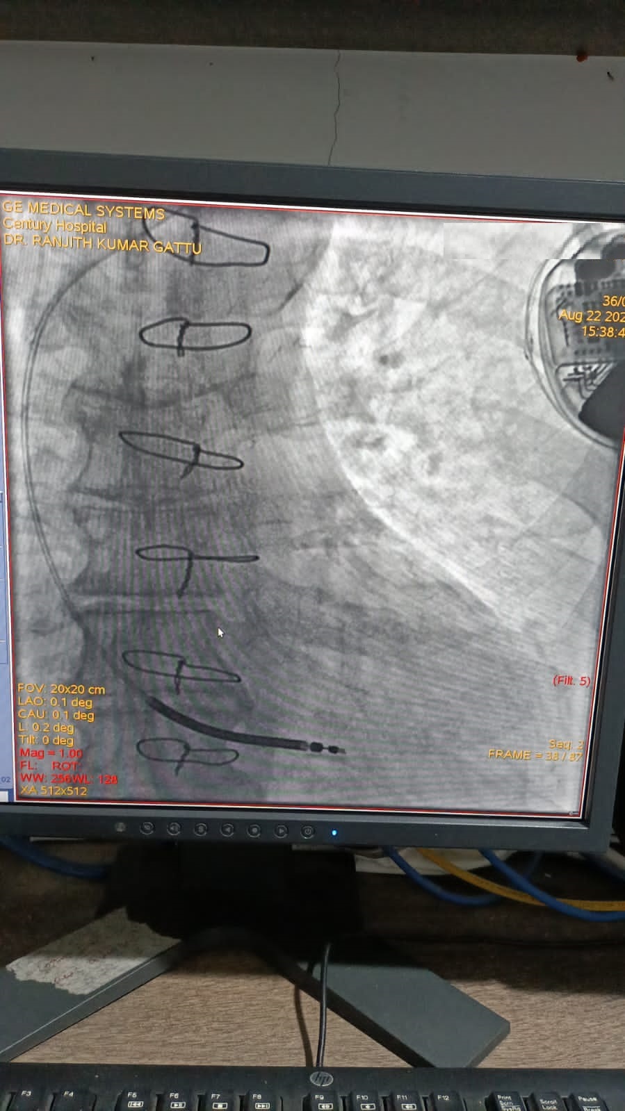 PTCA-RCA pre and post