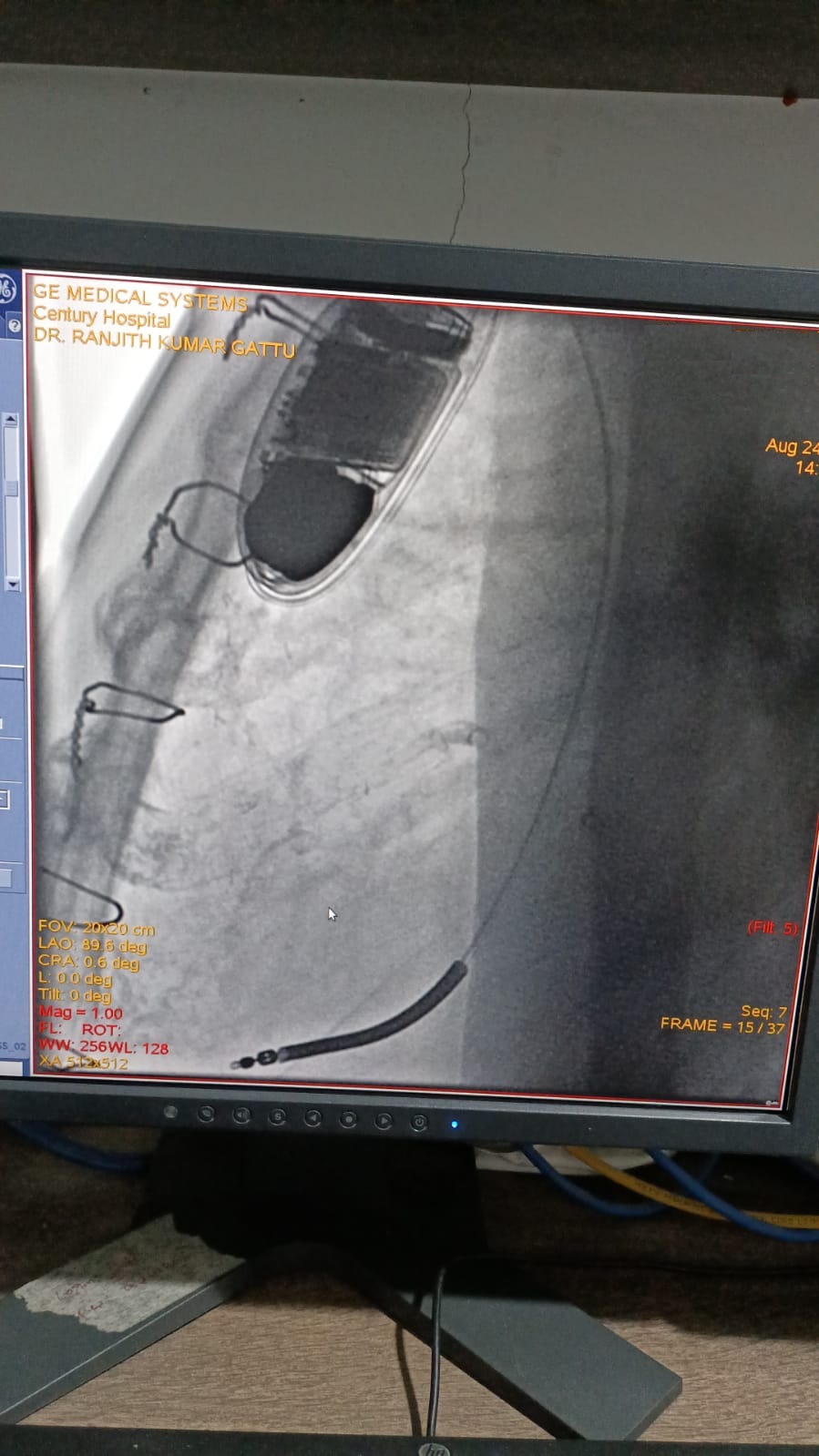 PTCA-RCA pre and post
