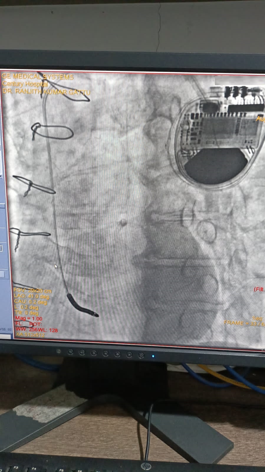 PTCA-RCA pre and post