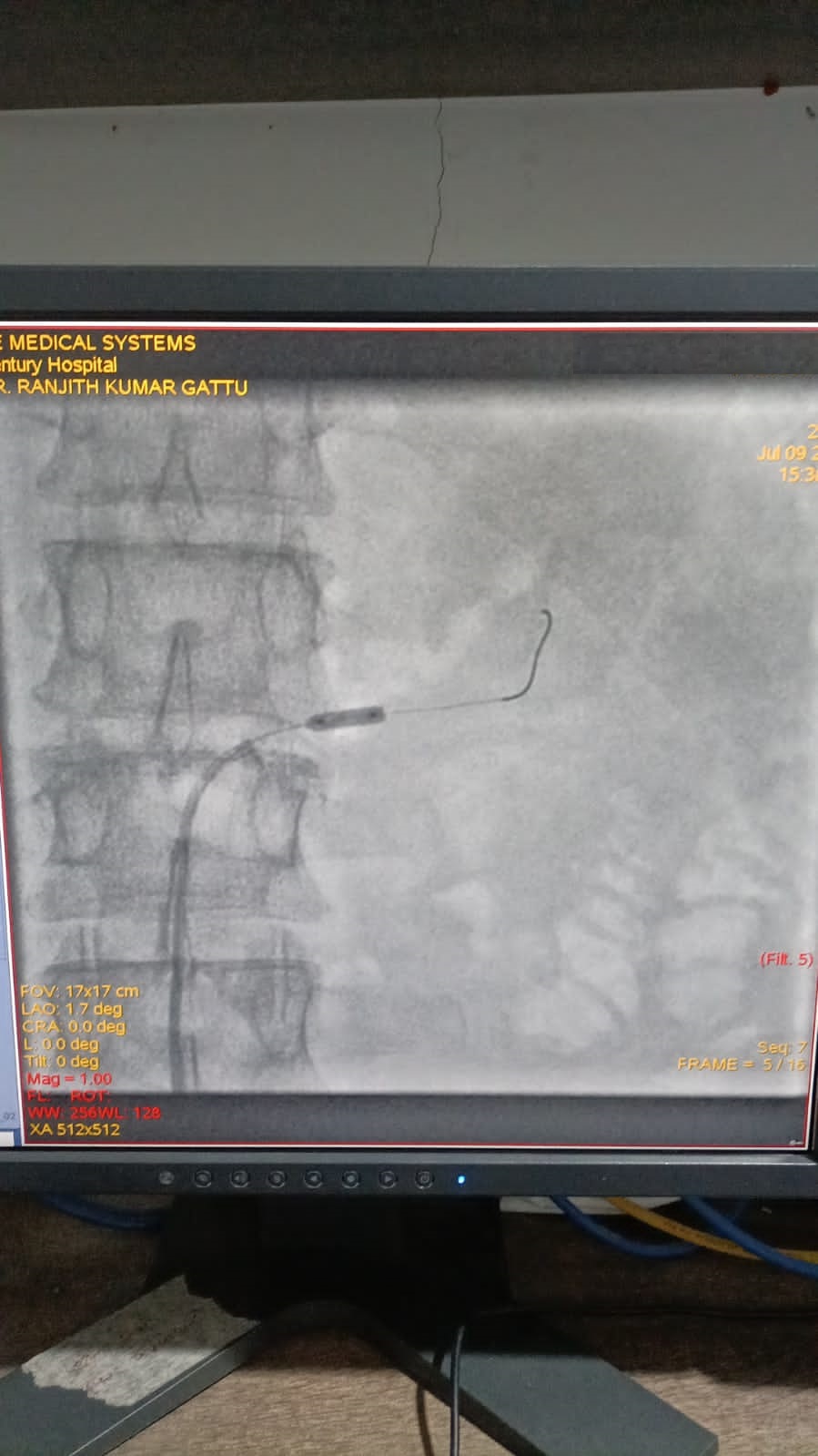 PTRA to left renal stenting