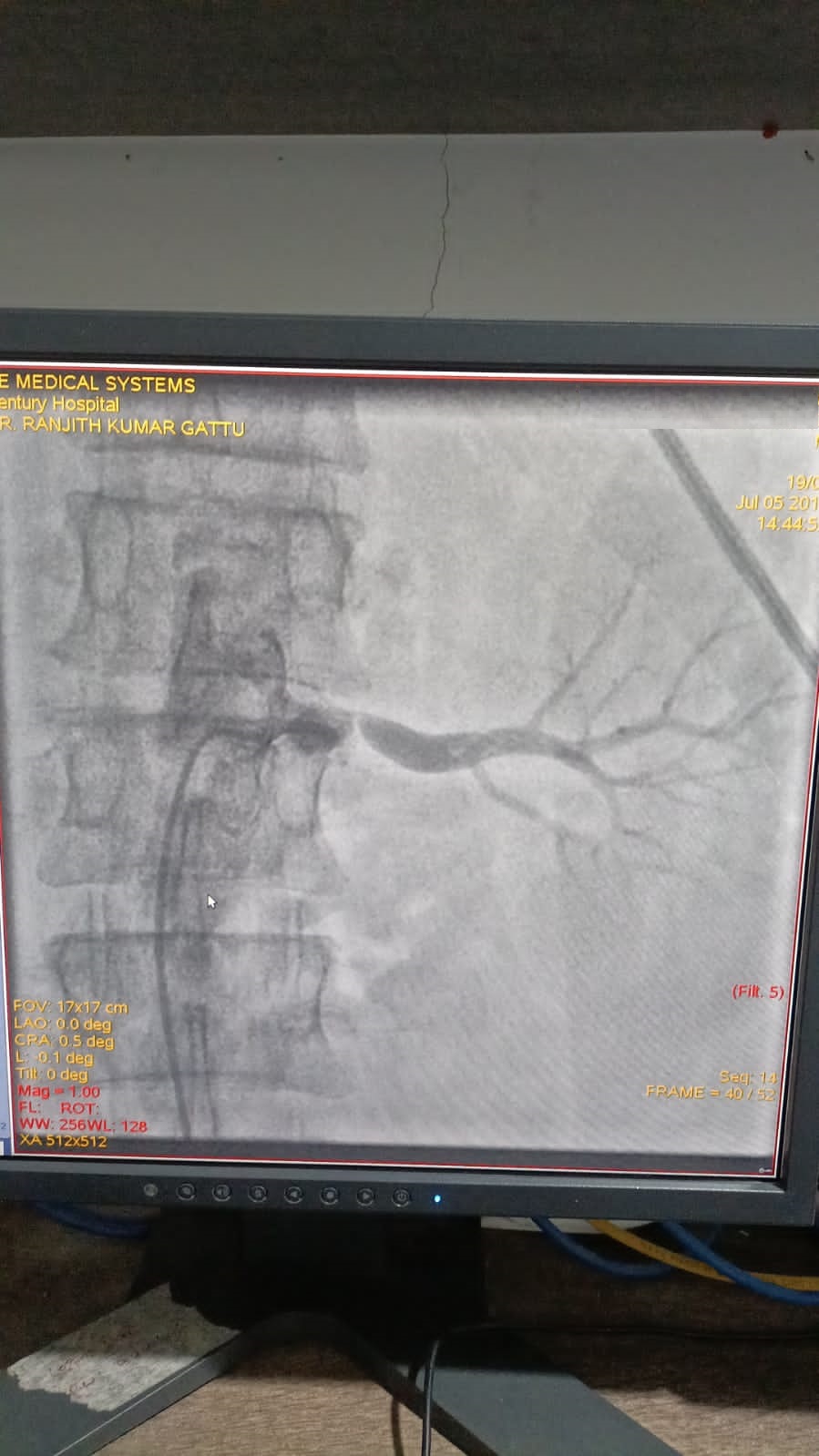 PTRA to left renal stenting