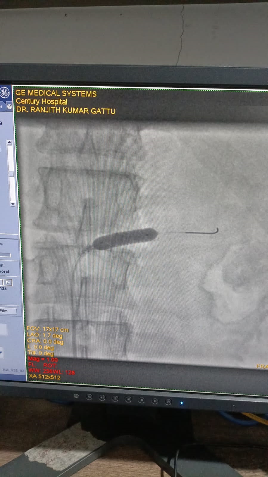PTRA to left renal stenting