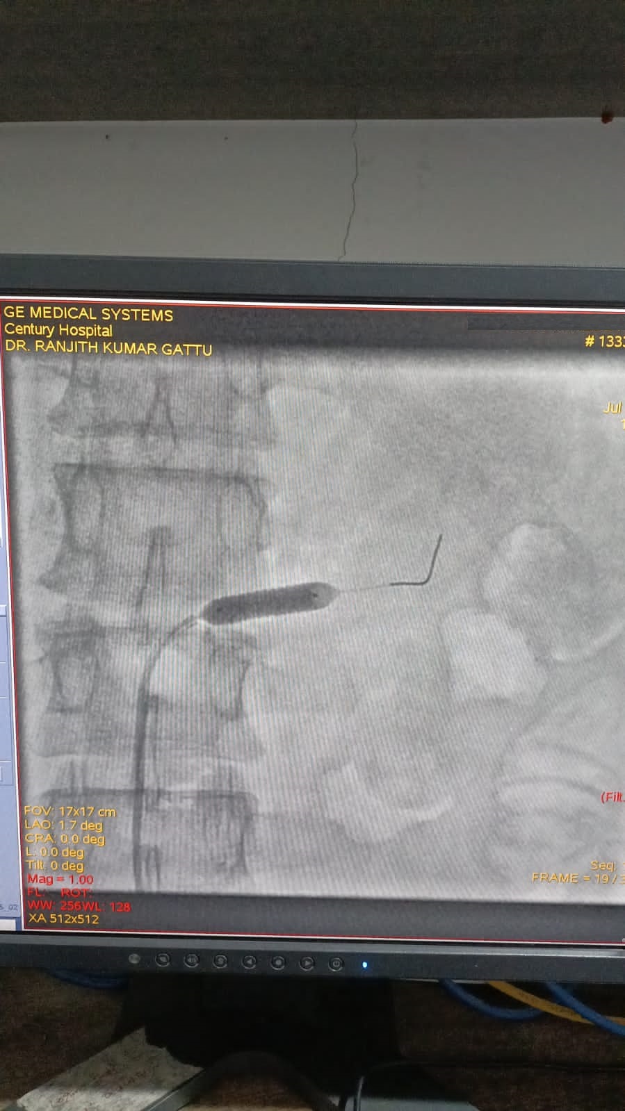 PTRA to left renal stenting