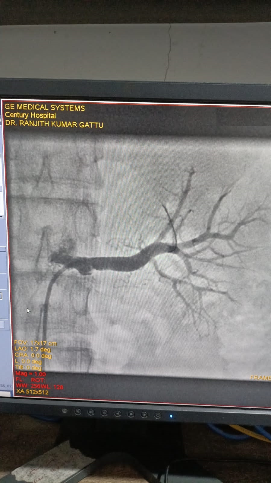 PTRA to left renal stenting