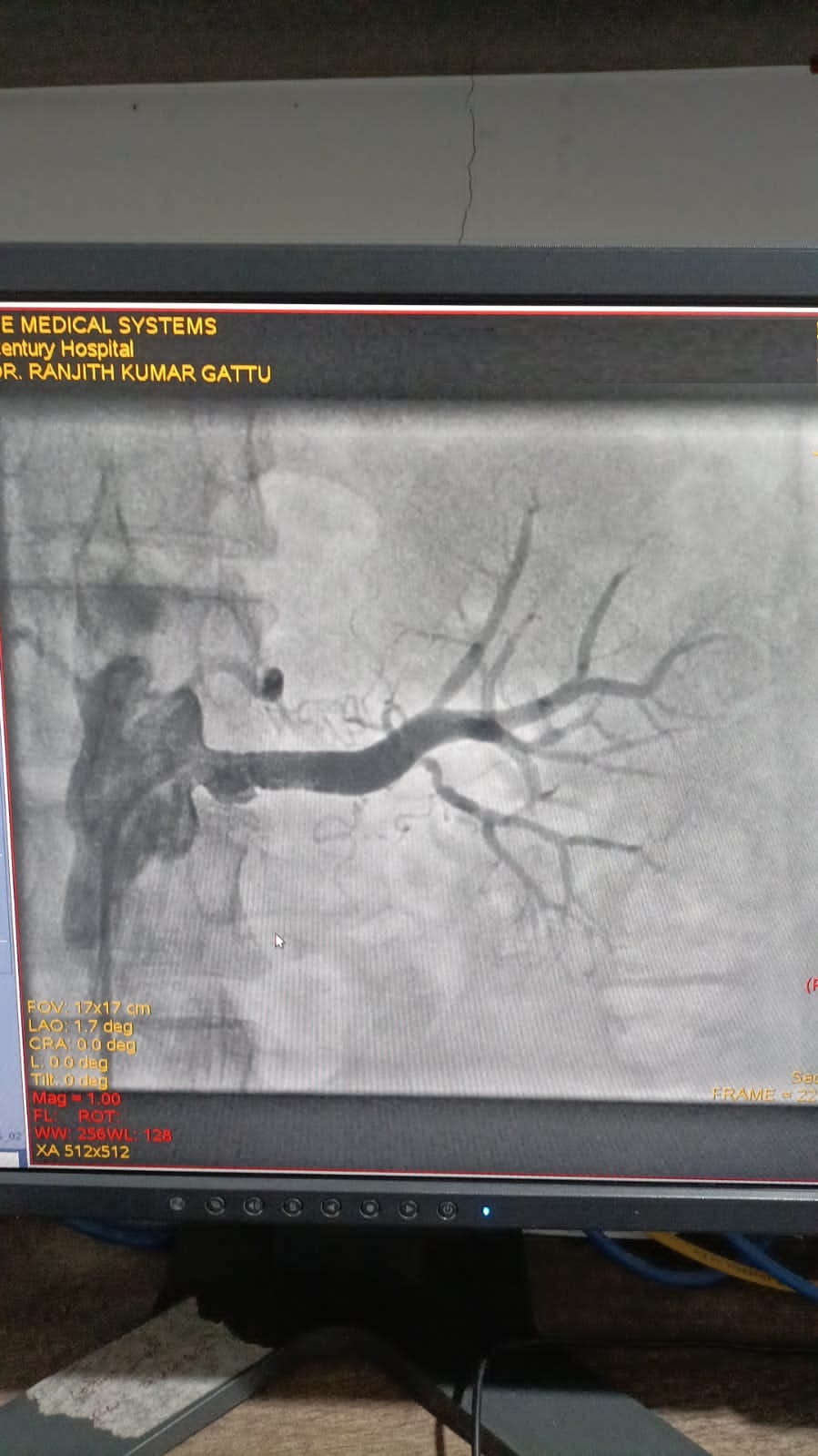 PTRA to left renal stenting