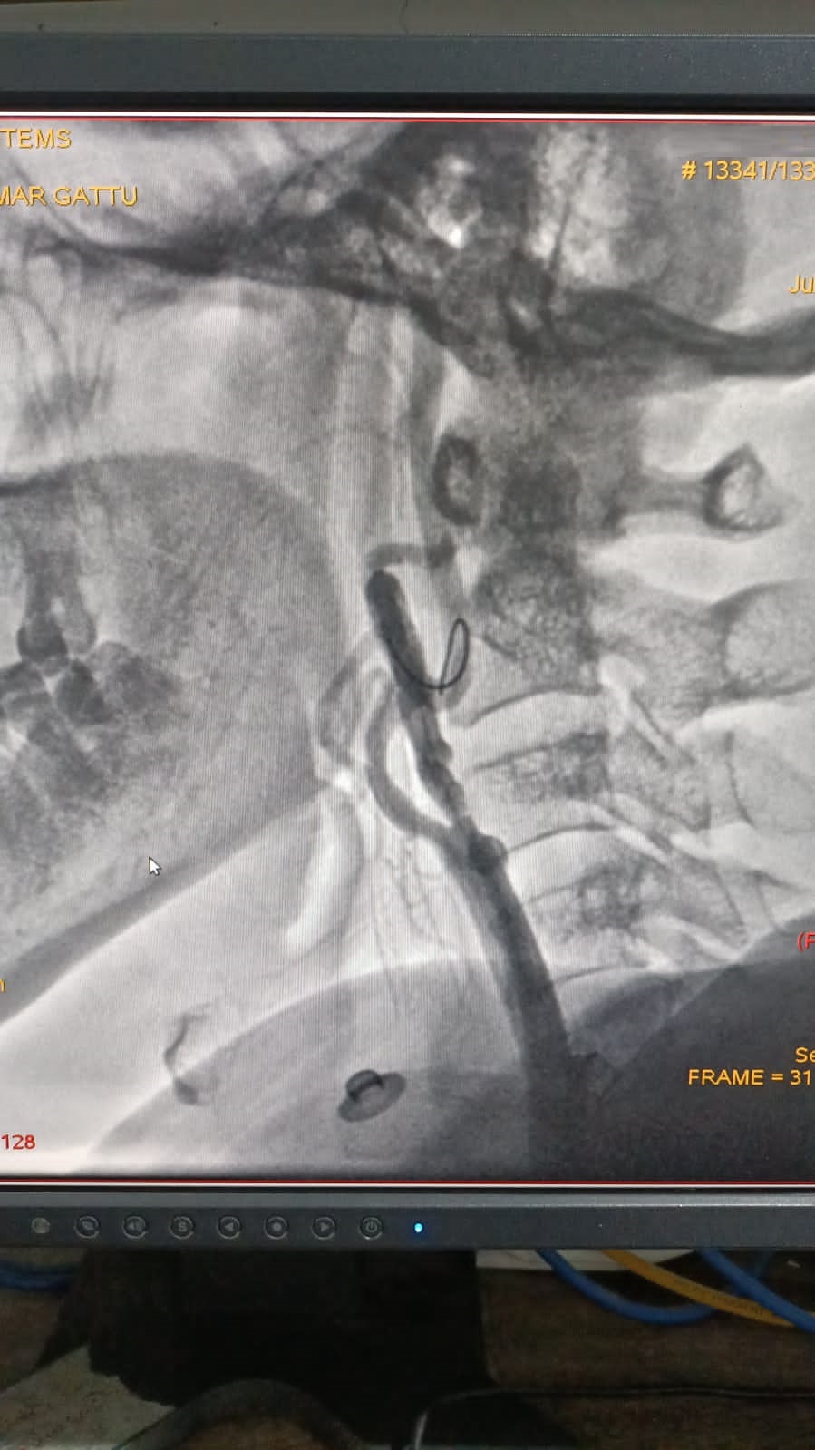 Right carotid artery stenting
