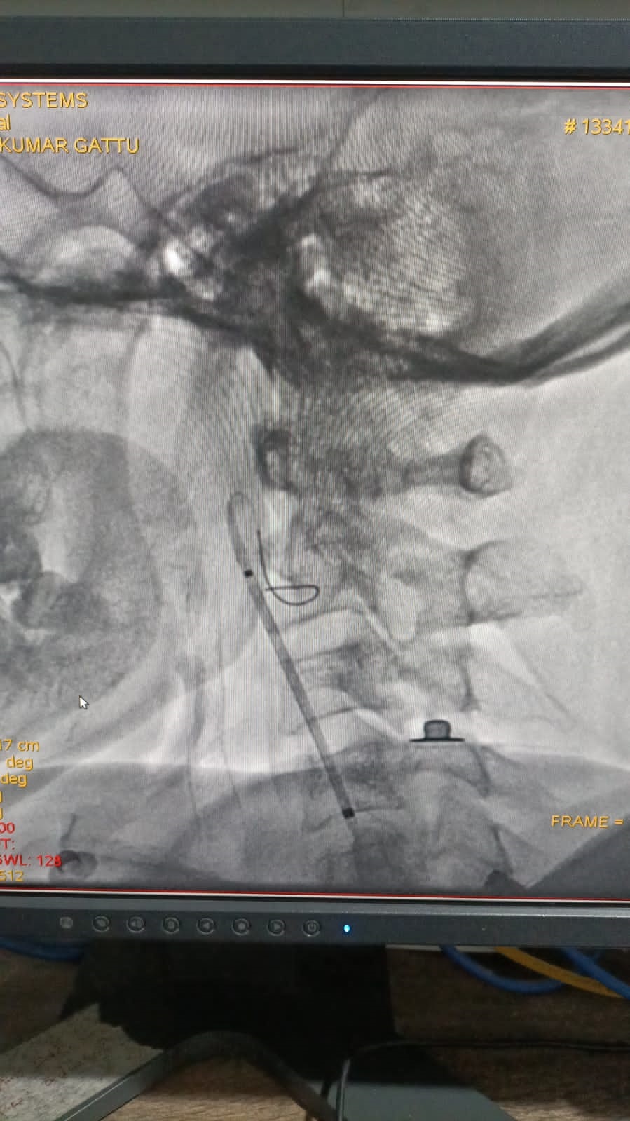 Right carotid artery stenting