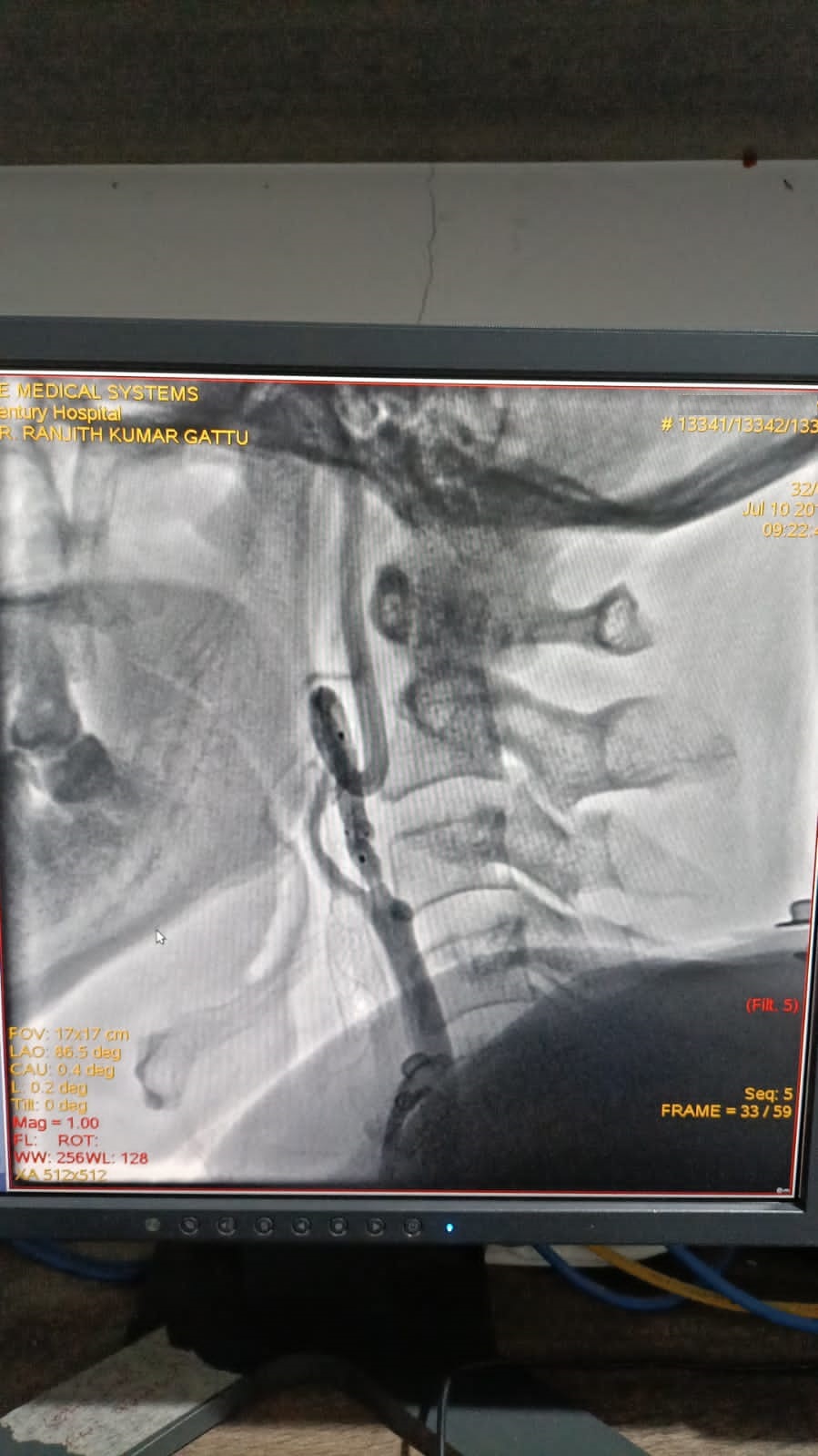 Right carotid artery stenting