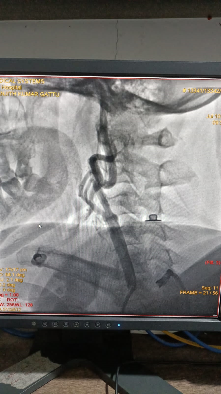 Right carotid artery stenting